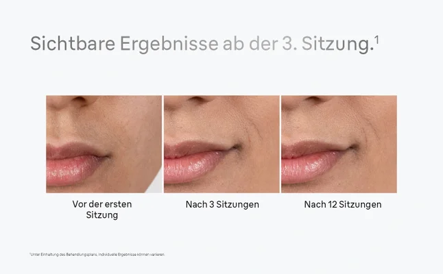 Der geteilte Bildschirm zeigt Bilder des Mundbereichs vor und nach Behandlung mit reduziertem Haar.